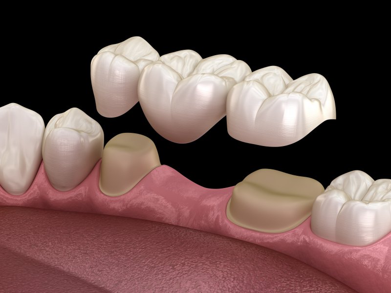 Illustration of dental bridge in Irving over natural teeth