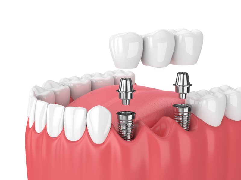 Implant bridge