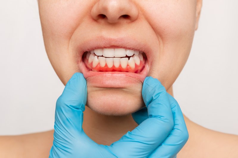 A gloved hand revealing a woman’s infected gums