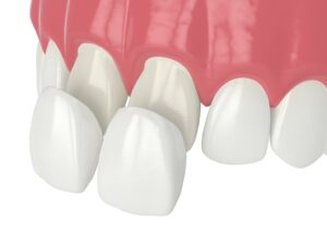 digital image of veneers